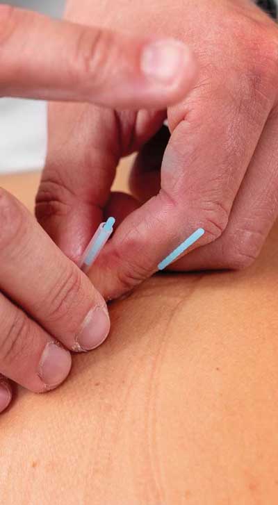 Symbolbild Akupunktur. Raphael Vergères setzt und richtet eine Akupunkturnadel