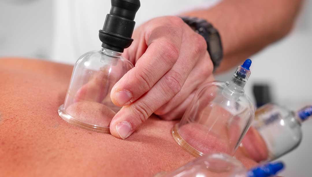 Symbolbild Schroepfen. Raphael Vergères setzt eine Schröpfkugel mit der Vakuumpumpe an die gewünschte Stelle.