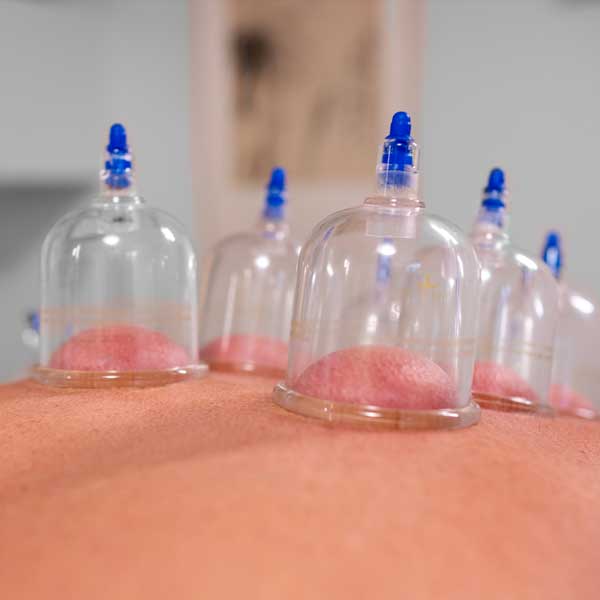 Symbolbild Schroepfen. Diverse Schröpfkugeln an den nötigen Stellen.