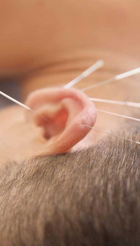 Teaserbild - Junger Mann erhält Ohrakupunktur
